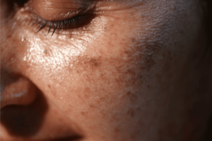 sun-damage-skin
